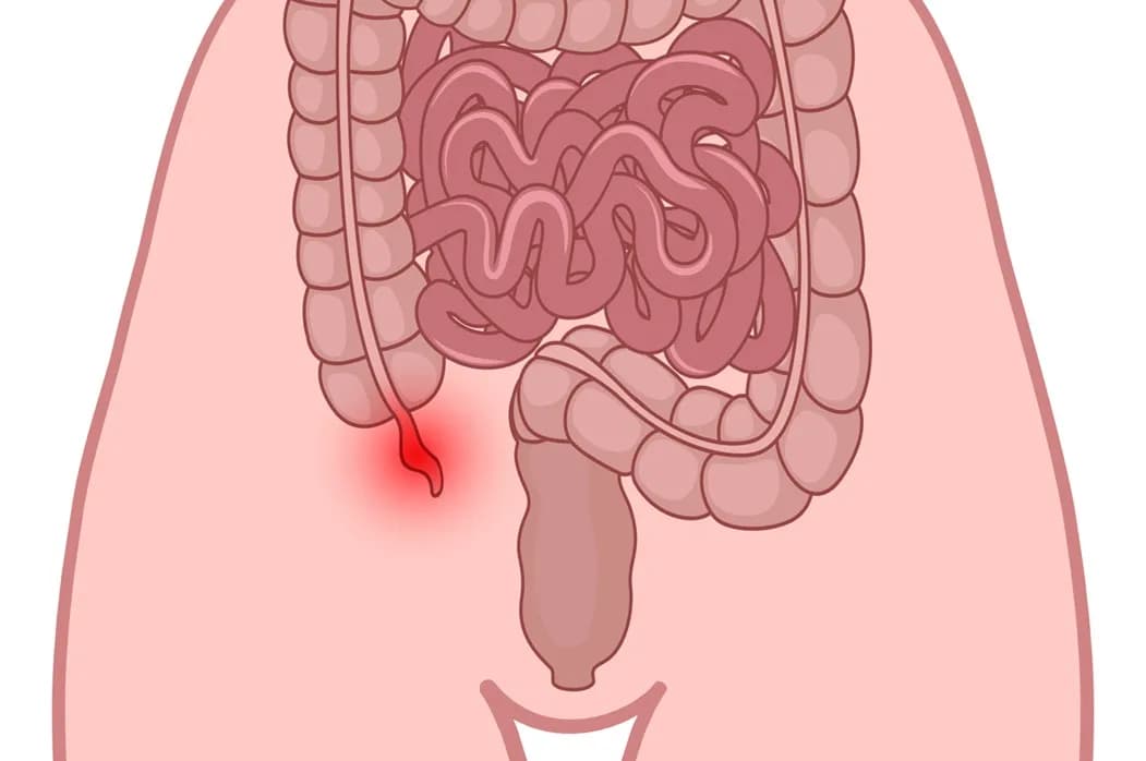 Objawy zapalenia wyrostka robaczkowego u dziecka – nie ignoruj tych sygnałów